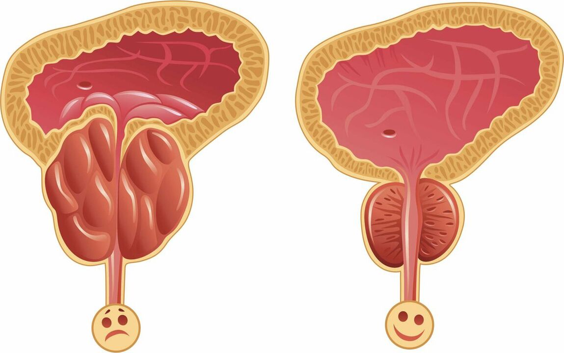 Простата преди и след лечение с капсули Prostaffect