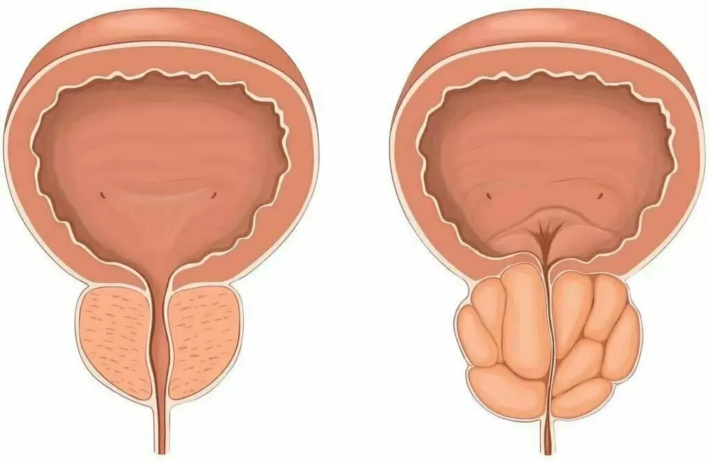 нормална простата и болна простата