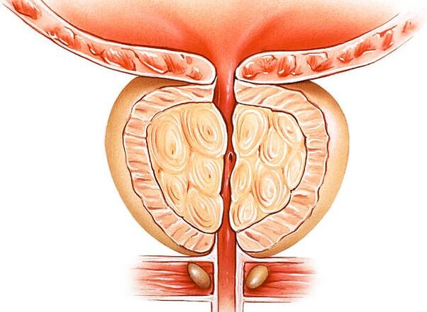 илюстрация на възпалена простата